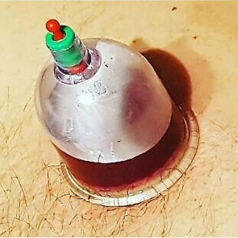 1 day hijama,cupping,course,certificate,beauty,clinic,massage,ipti,wet,fire,dry,training,classes