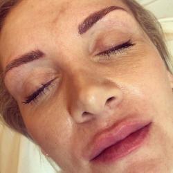 Lip & Facial FILLER