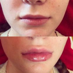 Lip & Facial FILLER