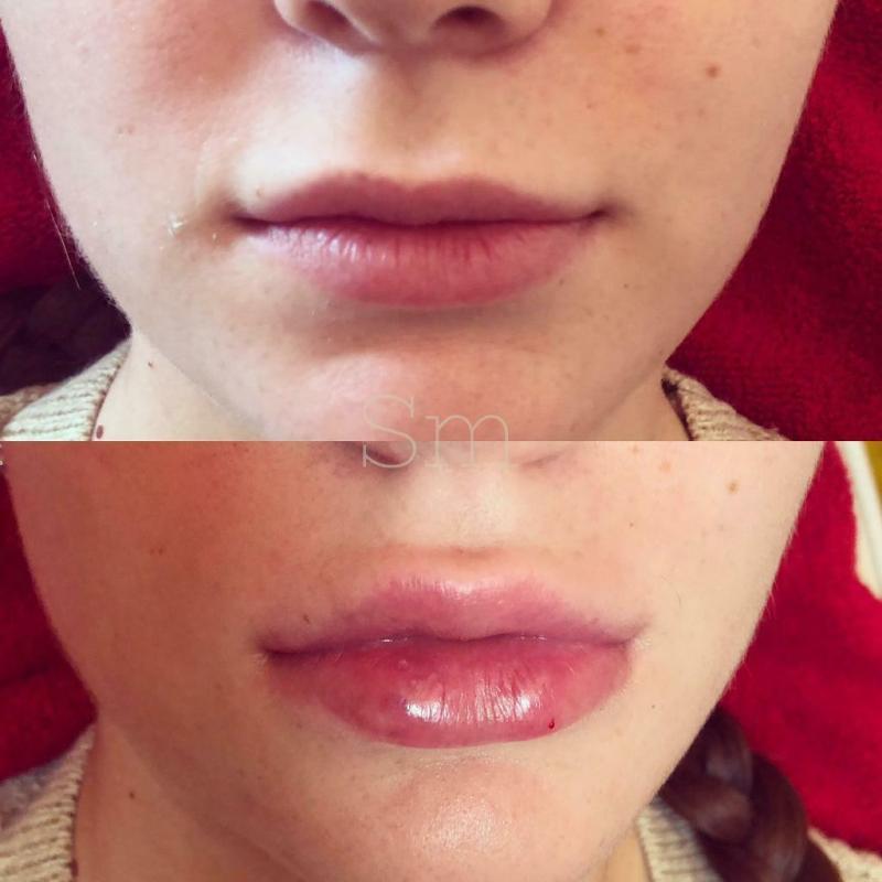 Lip & Facial FILLER