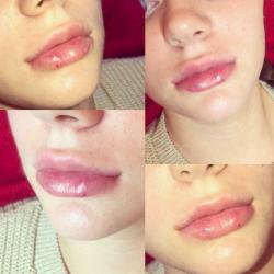Lip & Facial FILLER