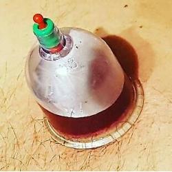 1 day hijama diploma course tretment mobile home outcall service beauty clinic class uk hot wet fire