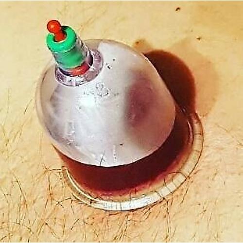 1 day hijama diploma course tretment mobile home outcall service beauty clinic class uk hot wet fire